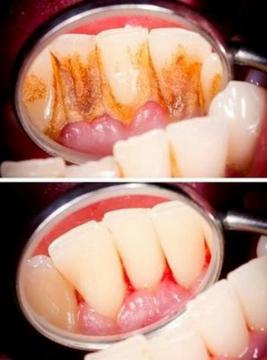 Limpieza Dental con Aclaramiento